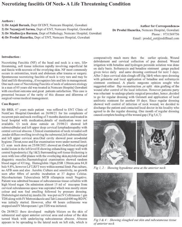 Necrotizing Fasciitis of Neck - A Life Threatening Condition