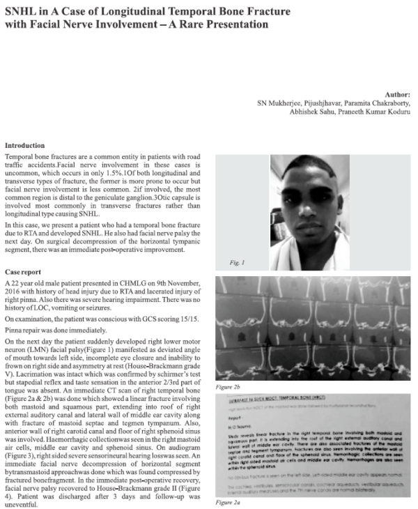 SNHL in a Case of Longitudinal Temporal Bone Fracture with Facial Nerve Involvement - A Rare Presentation